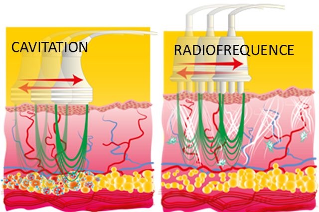 lipocavitation radiofrequence